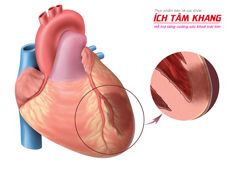 Suy vành gây nhồi máu cơ tim, khiến tim hoại tử nhanh nếu không cấp cứu kịp